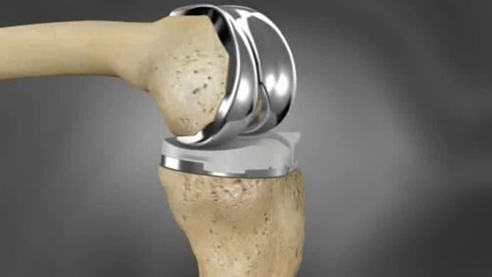Immagine di una protesi del ginocchio