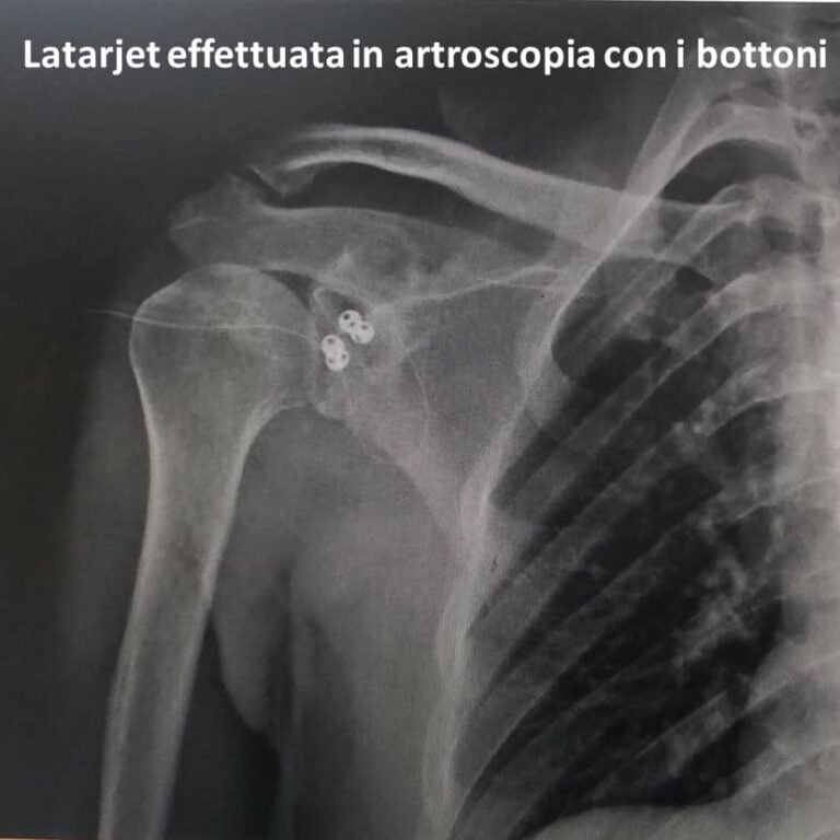 Latarjet_artroscopia_con_bottoni