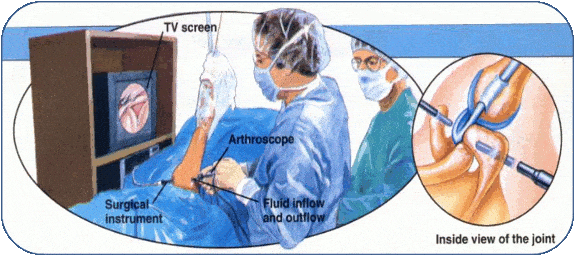 artroscopia-di-spalla-trattamento