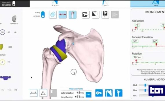 Le nuove frontiere dell'ortopedia Protesi-della-spalla-intelligenza-artificiale-Prof.-Francesco-Franceschi-ortopedico-spalla-Roma